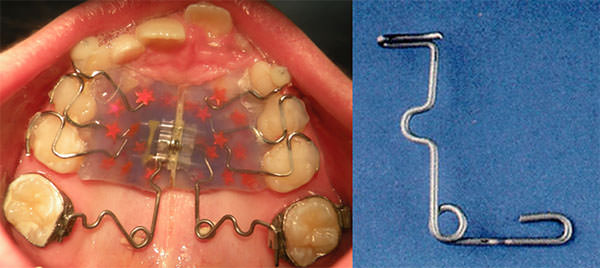 Fig. 10 Aparato ortopédico Pendex