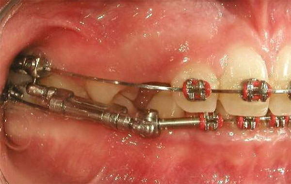 Fig. 11 Lateral derecha