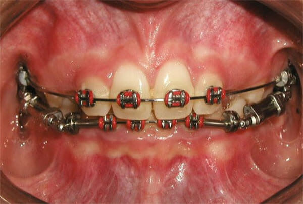 Fig. 13 Intraoral de frente