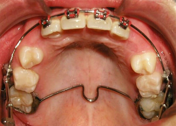 Fig. 14 Oclusal superior