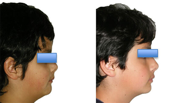 Fig. 16 Comparativa inicio, paciente de 8 años, progreso III, paciente 12 años 8 meses.