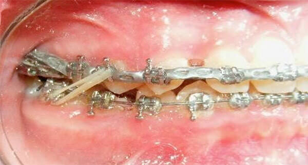 Fig. 17 Intraoral derecha