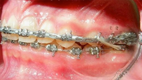Fig. 18 Intraoral izquierda