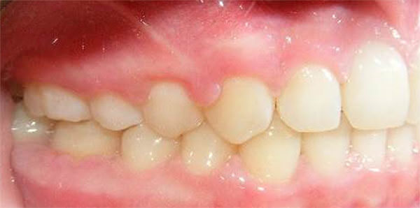 Fig. 21 Intraoral derecha