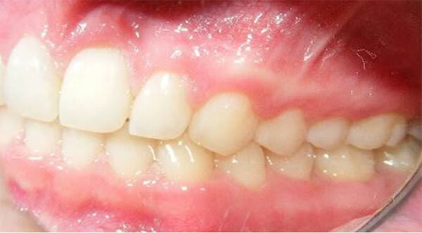Fig. 22 Intraoral izquierda