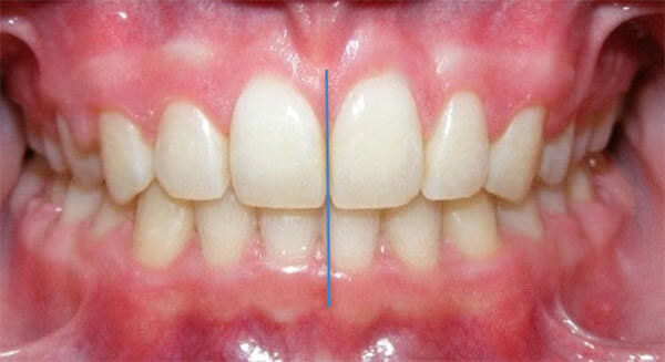 Fig. 23 Intraoral Frente