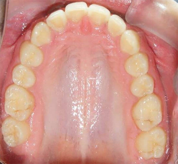 Fig. 24 Oclusal superior
