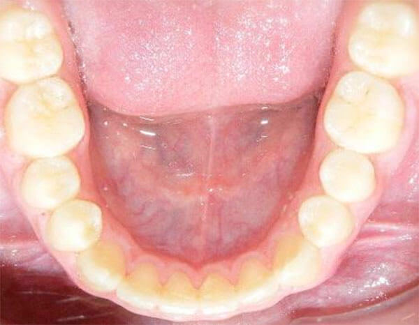 Fig. 25 Oclusal inferior