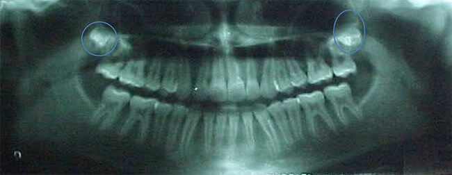 Fig. 26 Radiografía panorámica