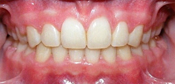 Fig. 27 Inicio y final del tratamiento