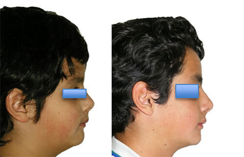 Fig. 8 Fotografías de perfil inicio y final.