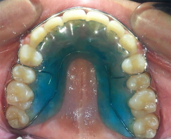 Fig. 29 Retenedor superior