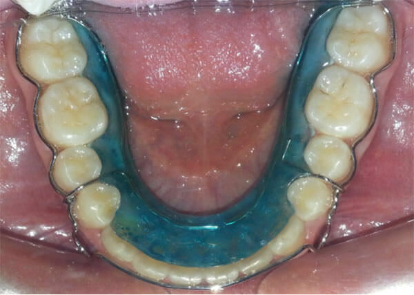 Fig. 30 Retenedor inferior