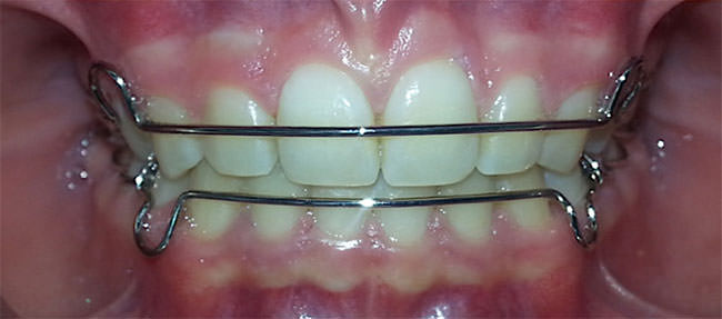 Fig. 31 Intraoral de frente retenedor
