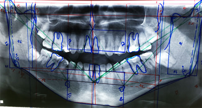 Fig.1 Trazado de Tatis