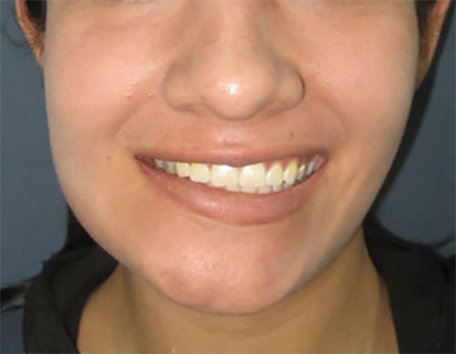 Fig. 2 Frontal Femenino 27 años de edad con dx de hiperplasia condilary por afección de comisura labial sin alteración de canteamiento oclusal HC2 de Wolford