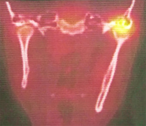 Fig. 3 TEP, Captación de radioisótpos
