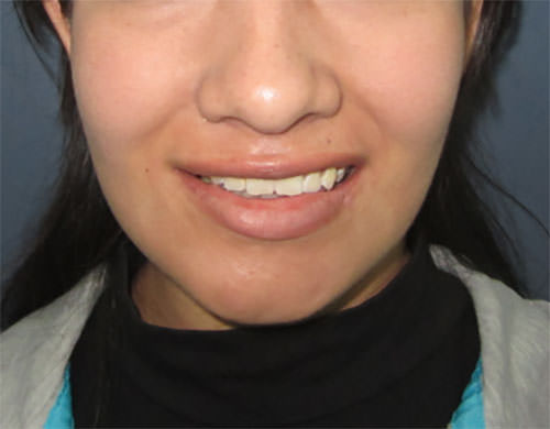 Fig 6 Correccción estética y funcional de comisura labial y mímica facial conservada.