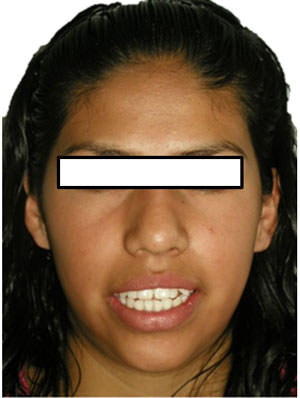 Fig.3 Sonrisa