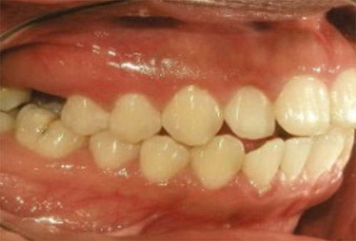 Fig.5 Lateral derecha