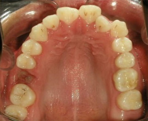 Fig.7 Oclusal superior