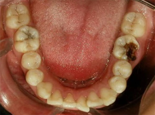 Fig.8 Oclusal inferior