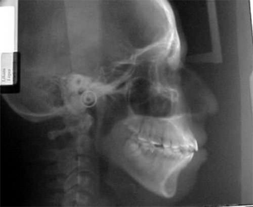 Fig.9 Radiografía lateral de cráneo inicial