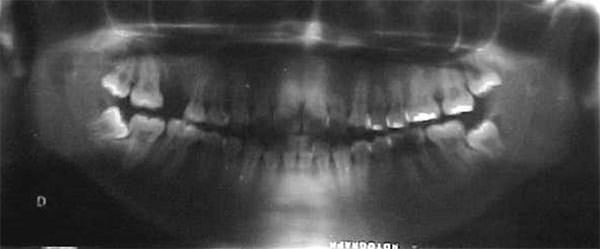 Fig.10 Radiografía panorámica