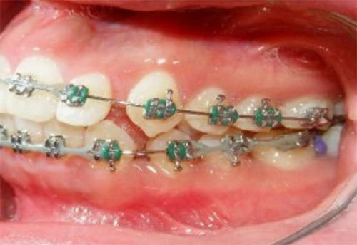Fig.12 Lateral izquierda