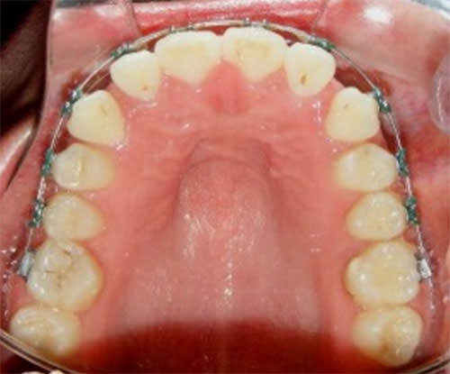 Fig.13 Oclusal superior