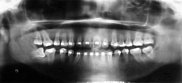 Fig.15 Radiografía panorámica de progreso