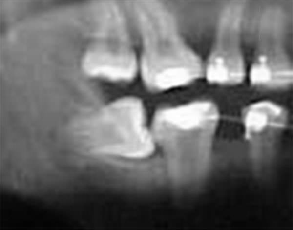 Fig. 16 Progreso