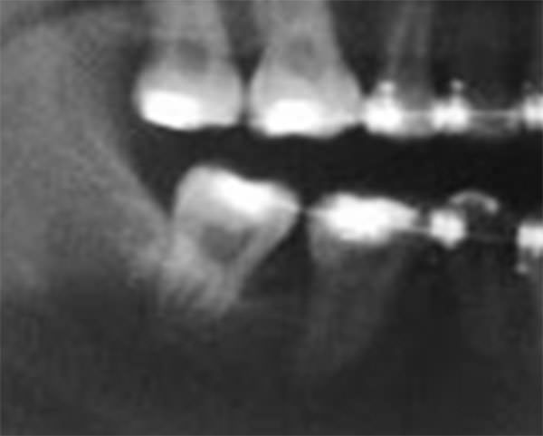 Fig. 17 Progreso