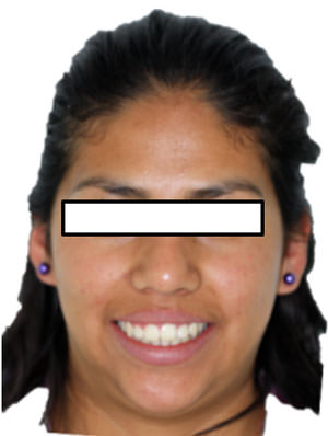 Fig.21 Sonrisa