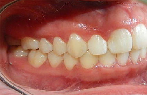 Fig.22 Lateral derecha