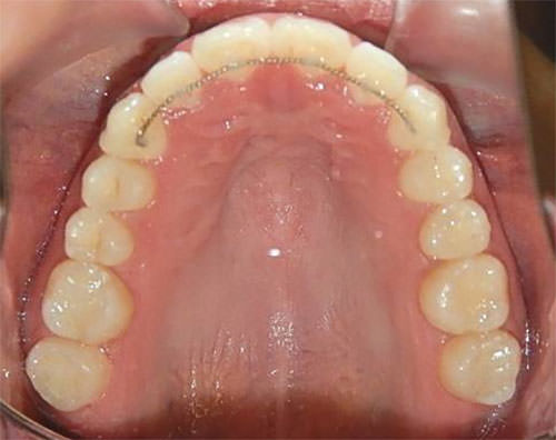 Fig.25 Oclusal superior