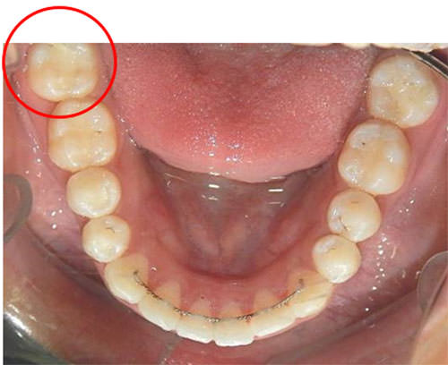 Fig.26 Oclusal inferior