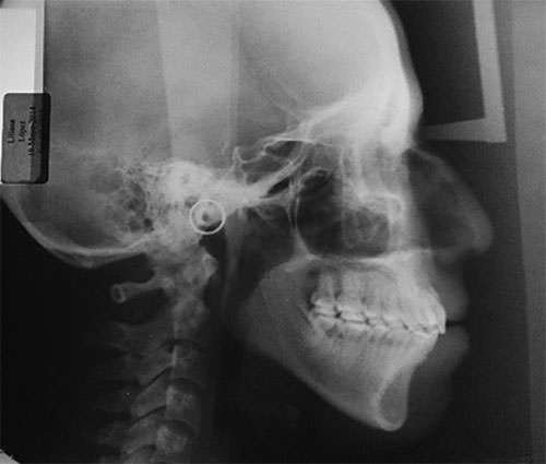 Fig.27 Lateral de cráneo final