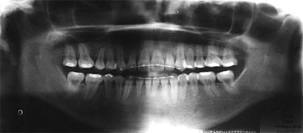 Fig.28 Radiografía panorámica final
