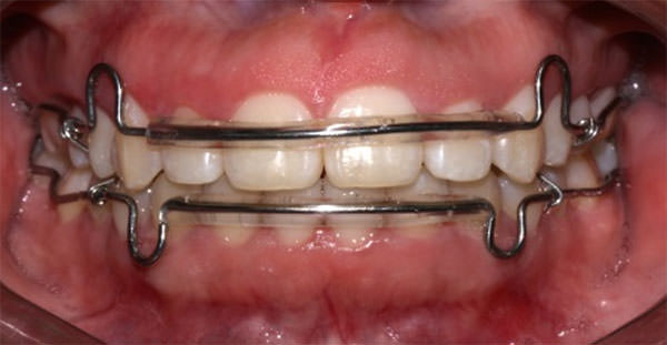 Fig.30 Frente