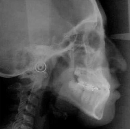 Fig. 1 Radiografía lateral de cráneo de inicio