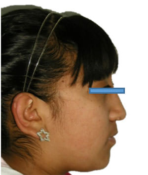 Fig.2 Extraoral de perfil