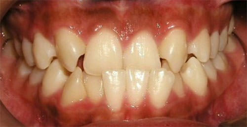 Fig. 4 Intraoral frontal