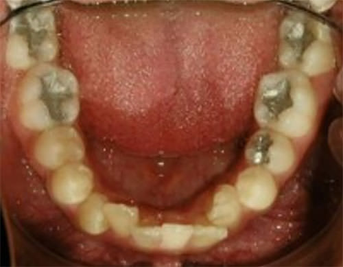 Fig.6 Oclusal inferior