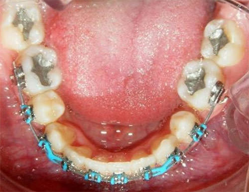 Fig. 8 Oclusal Inferior de progreso