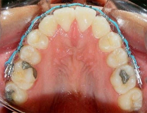 Fig. 9 Superior progreso