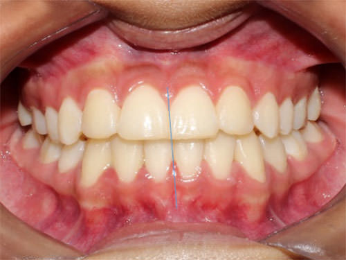 Fig. 10 Frente Intraoral final
