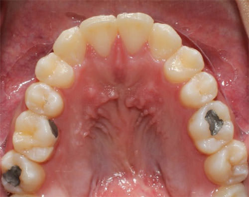 Fig. 11 Comparativo de inicio a final, vista oclusal superior