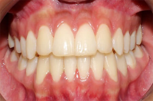 Fig.15 Frente, la paciente inicio con clase III canina y mordida cruzada anterior y al final del tratamiento termino con clase I canina bilateral y adecuado overjet y overbite.