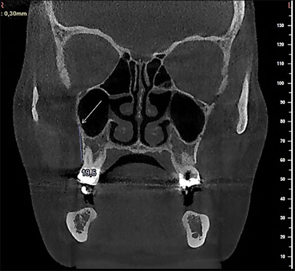 Fig. 1 Imagen coronal del paquete vascular alveoloantral a nivel del segundo molar maxilar derecho